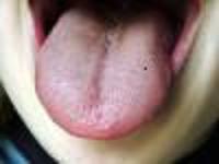 舌苔が溜まりやすい舌の形状（裂溝舌）